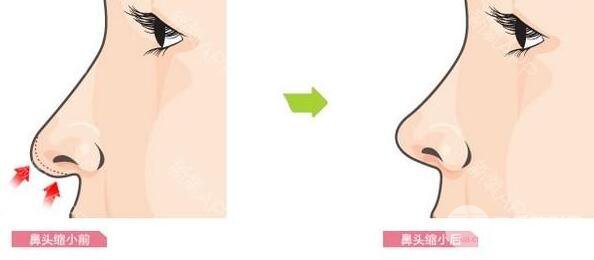 鼻头缩窄恢复期要多久？术后怎样护理恢复快？