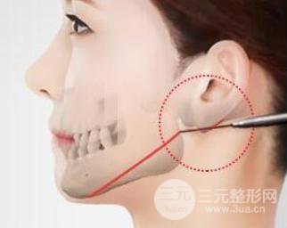 磨腮削骨风险大吗?手术后遗症有哪些?