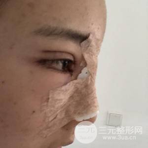 生物焊接双眼皮一个月的样子 真实果图对比 图片分享