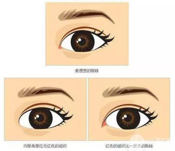 北京开内眼角价格一般多少