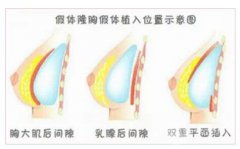 隆胸微创手术一般需要多少钱