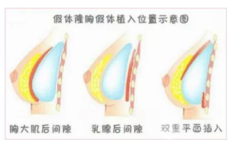 隆胸微创手术一般需要多少钱