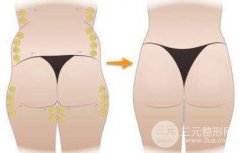 玻尿酸丰臀安不降低风险?玻尿酸丰臀的可靠性怎么样?