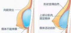 双平面隆胸有什么优缺点?