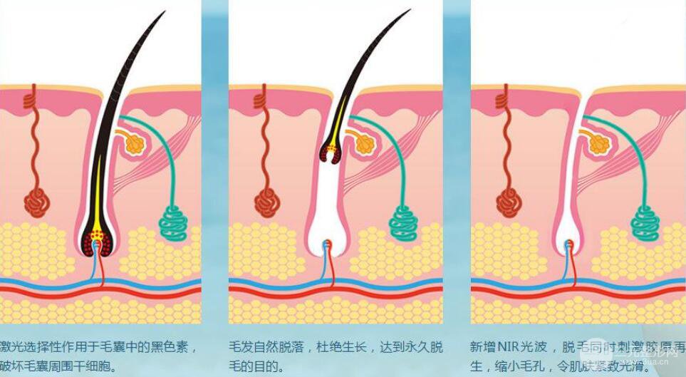 半导体激光脱毛适应症有哪些呢?