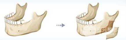 下颌后缩矫正费用贵不贵？术后果如何维持？