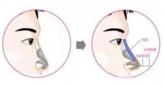 鼻中隔软骨隆鼻后能维持多久? 鼻中隔软骨隆鼻后能维持多久?