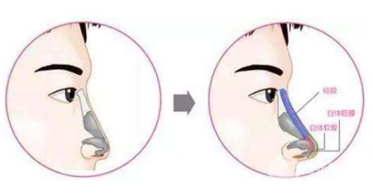 鼻中隔软骨隆鼻后能维持多久?