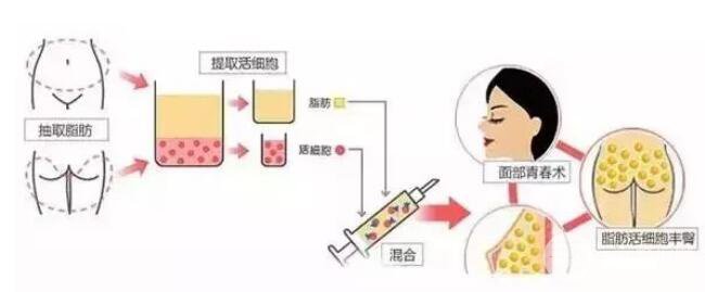 活细胞填充有后遗症吗?后遗症有哪些?