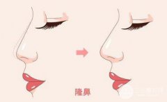双美胶原蛋白隆鼻果怎么样？成好吗？