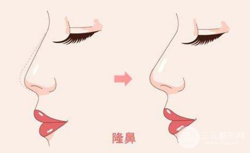双美胶原蛋白隆鼻果怎么样？成好吗？