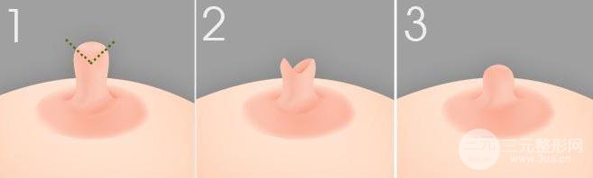 乳头缩小的手术多少钱?费用标准的影响有?