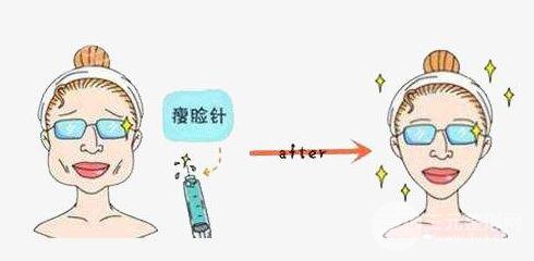 注射注射瘦脸瘦脸的副作用严重吗？需要注意什么