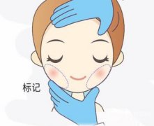 玻尿酸垫下巴多久消肿？需要注意什么？
