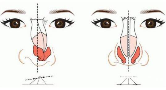 膨体材料隆鼻成好吗?膨体隆鼻果怎么样?