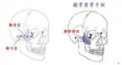 颧骨降低做完后需要多长时间恢复?