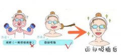 面部精细吸脂怎么做的?面部精细吸脂步骤?