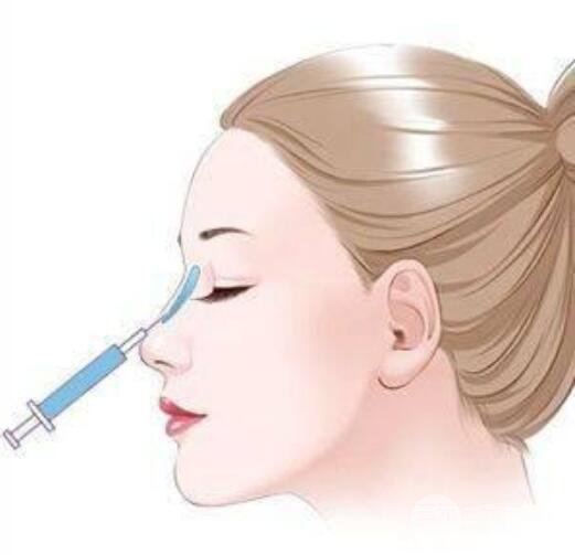 注射垫鼻梁成好吗？能维持多久？