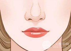 鼻翼宽怎么改良?鼻翼缩小的方法有哪些? 鼻翼宽怎么改良?鼻翼缩小的方法有哪些?