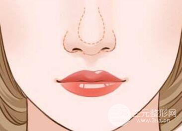 鼻翼宽怎么改良?鼻翼缩小的方法有哪些?