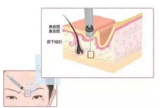p注射美容一般做一次需要多少钱?影响价格的因素有哪些?