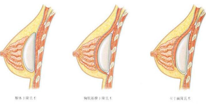 双平面隆胸技术成熟了吗