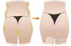 玻尿酸丰臀靠谱吗?玻尿酸丰臀如何做好护理工作?