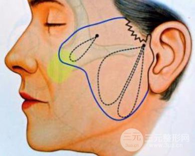 悬吊除皱术可以做几次?美肤果持久吗？