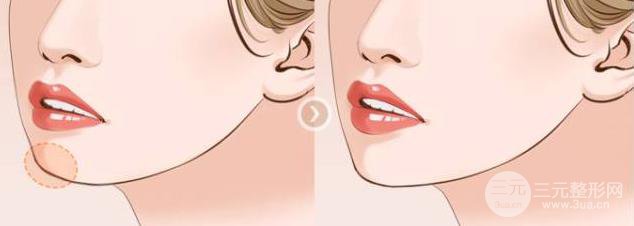 成都注射伊w兰丰下巴需要多少钱?果如何？