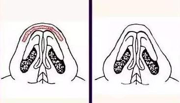 膨体材料隆鼻需要多少钱？价格影响有哪些？