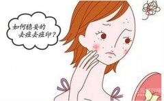 镭射去痘印果怎么样