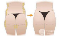 玻尿酸丰臀成好吗?可以维持多久?