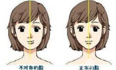 左右脸不对称怎么办？有什么解决方法？