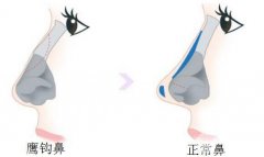 鹰钩鼻矫正方法有什么?手术过程是怎样的? 鹰钩鼻矫正方法有什么?手术过程是怎样的?