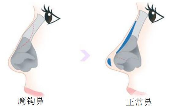 鹰钩鼻矫正方法有什么?手术过程是怎样的?