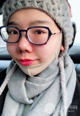 去颊脂垫对比