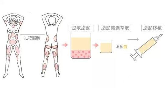 成都军大医院自体填充果好不好?收费贵吗?