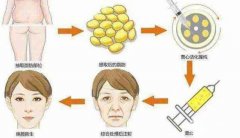 成都军大自体脂肪填充术后如何护理果持久? 成都军大自体脂肪填充术后如何护理果持久?