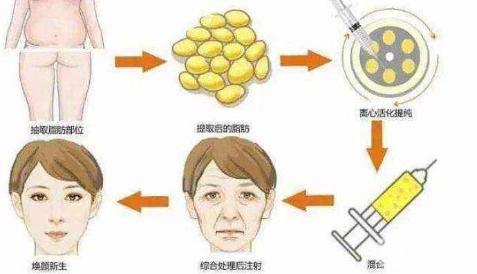 成都军大自体脂肪填充术后如何护理果持久?