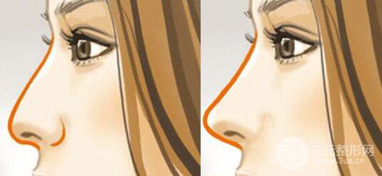 成都蜀尚蓉雅做假体隆鼻多少钱？价格影响有？