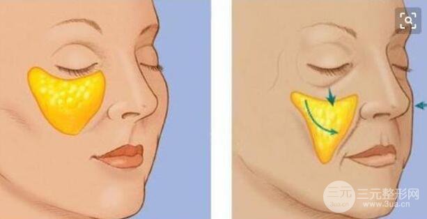 活体脂肪填充出现回缩情况需要补填吗?