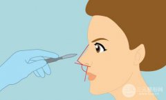 成都隆鼻整形手术多少钱?如何做好术后护理工作?