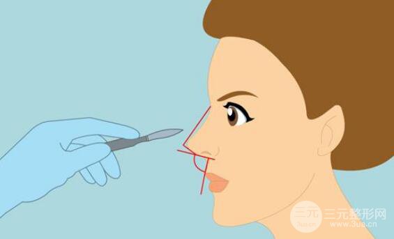 成都隆鼻整形手术多少钱?如何做好术后护理工作?