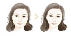 颌面整形属于几级手术?手术的可靠性怎么样?