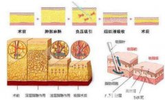 吸脂术后有何不良反应?如何解决?