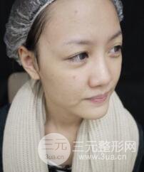 成都光子嫩肤