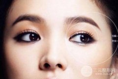 全切双眼皮成好吗?恢复期多久?