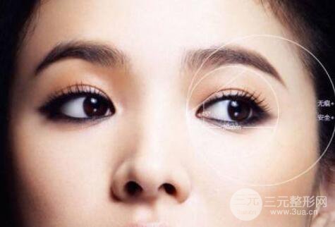 全切双眼皮成好吗?恢复期多久?