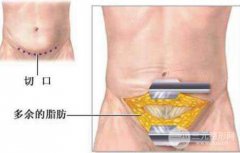 腹壁整形并发症有哪些?可能造成哪些影响?