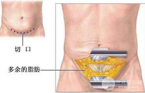 腹壁整形并发症有哪些?可能造成哪些影响?